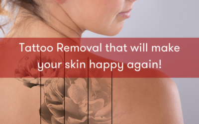 All About Laser Tattoo Removal