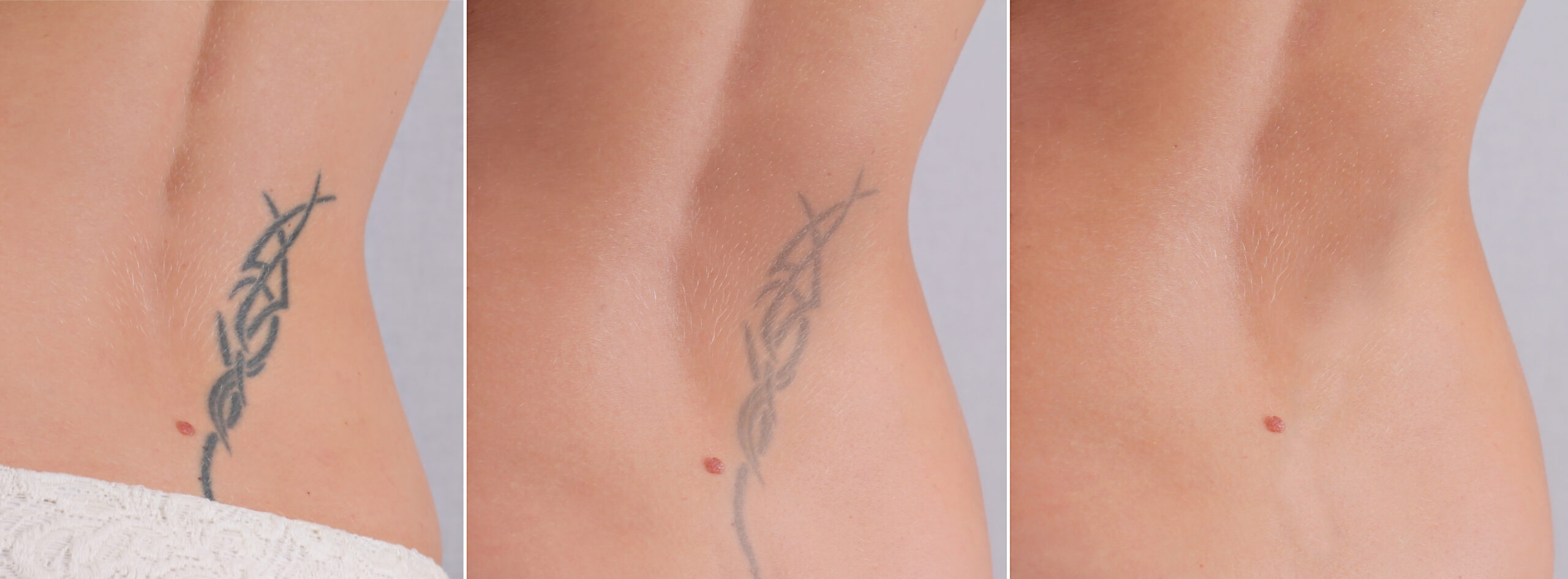 PAINLESS TATTOO REMOVAL  Canton MA Patch