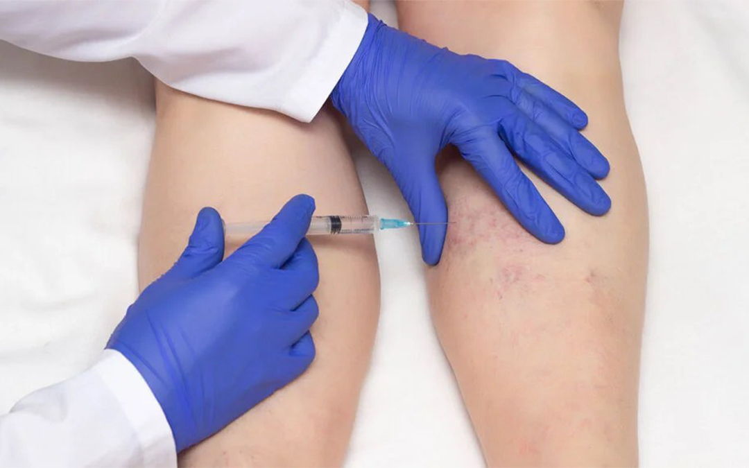Sclerotherapy Reticulated Vein and Spider Vein Treatment