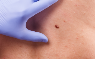 Mole Removal Without Scarring Using Pelleve®