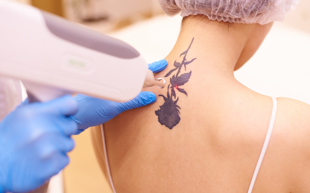 Erasing the Past: The Ultimate Guide to Laser Tattoo Removal