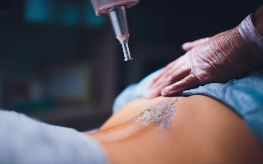 PicoSure Tattoo Removal Vs. Traditional Tattoo Removal