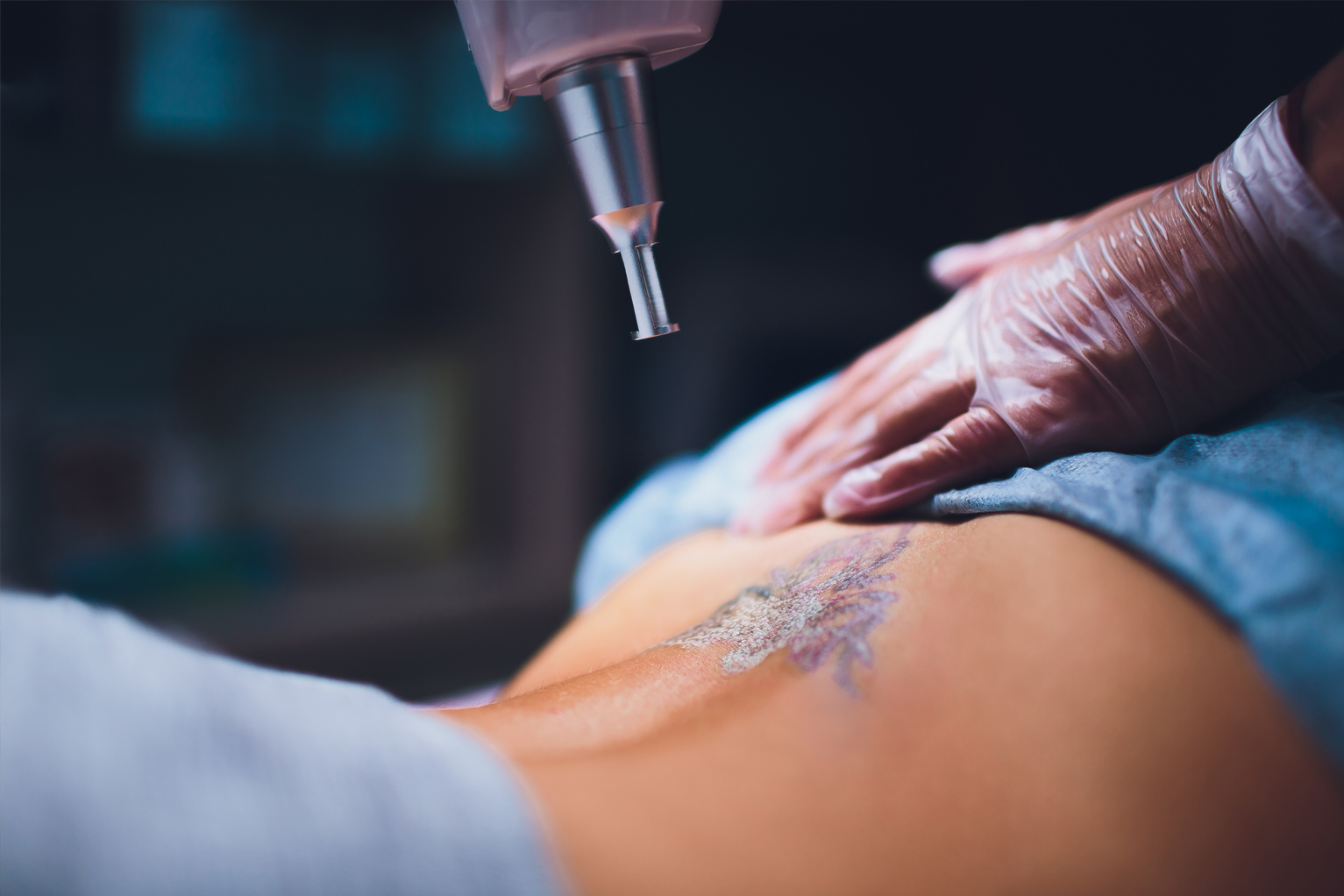 Proper Aftercare Instructions for Laser Tattoo Removal
