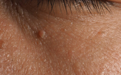 Get Gorgeous Skin With Pelleve Skin Tag Removal