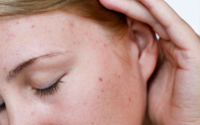 Common Skin Concerns Addressed by Laser Treatments: From Acne Scars to Age Spots