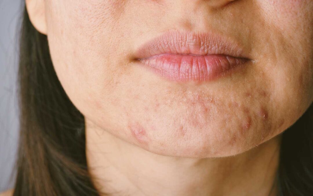 Winter Recovery: Treating Acne Scars and Wrinkles with RF Microneedling